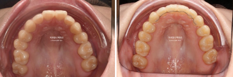 인비절라인 교정 비발치 비대칭 덧니 중심선 선천적 결손치 교정? 관련 이미지 16