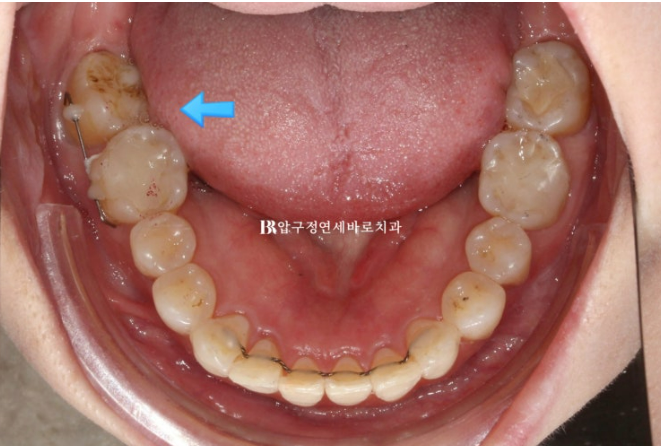 Invisalign Lite for Orthodontic Treatment in Your 40s: Crossbite and Protrusive Mouth Correction image 11