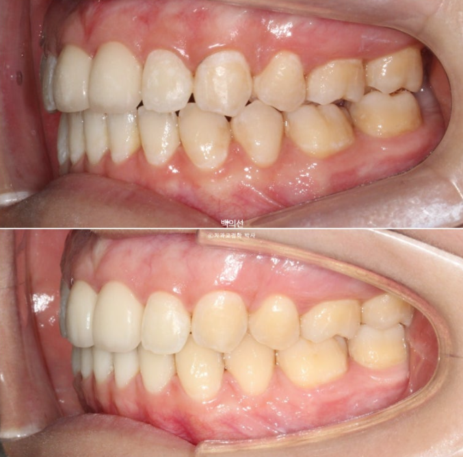 클리피씨 교정에서 인비절라인 변경 마무리 인비절라인 라이트 치료기간 4개월 관련 이미지 14