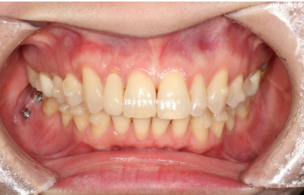 Can Invisalign Lite Work for Patients in Their 40s? A Real Case Improving Scissor Bite and Deep Bite in 10 Months image 9