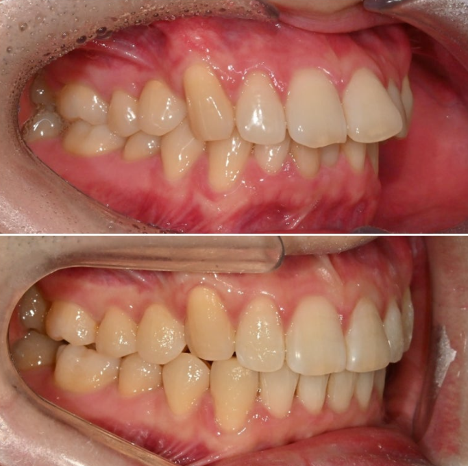 인비절라인 라이트 돌출 과개교합 중심선 교정 치간삭제 치료기간 관련 이미지 1