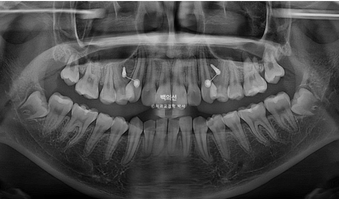비발치 덧니교정 인비절라인 교정 사랑니 이용 교정 관련 이미지 9