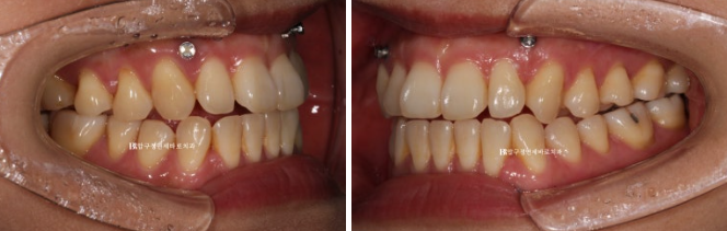양악수술 선수술 교정 후기 인비절라인 교정 관련 이미지 5