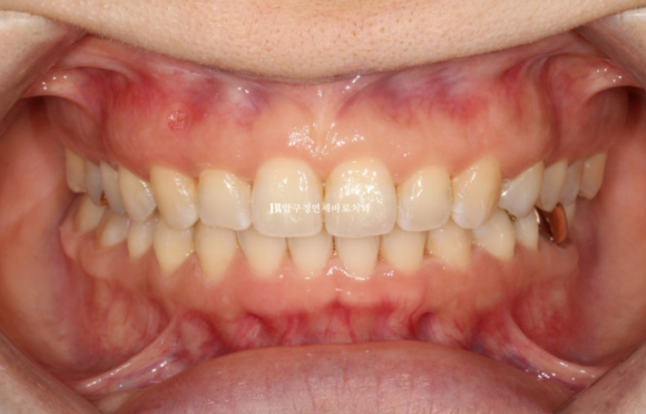 인비절라인 캔팅 교정 과개교합 교정 임플란트 재교정 관련 이미지 8