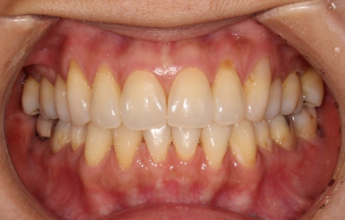 How Can Black Triangles Be Removed? Is Re-treatment Orthodontics an Option? image 6