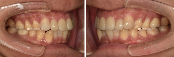 40대 치아교정 인비절라인 라이트 덧니 교정 어금니 교합 부작용 관련 이미지 3