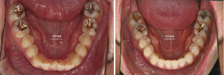 30대 MSE 악궁확장 덧니 반대교합 비발치 클리피씨 부작용 관련 이미지 16