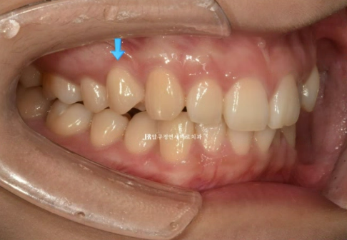 급속 교정 앞니부분교정 치료 무삭제 라미네이트 후기 관련 이미지 5