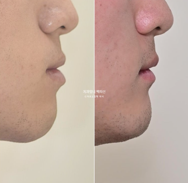 투명교정 인비절라인 덧니 교정 치료기간 알아보기 관련 이미지 16