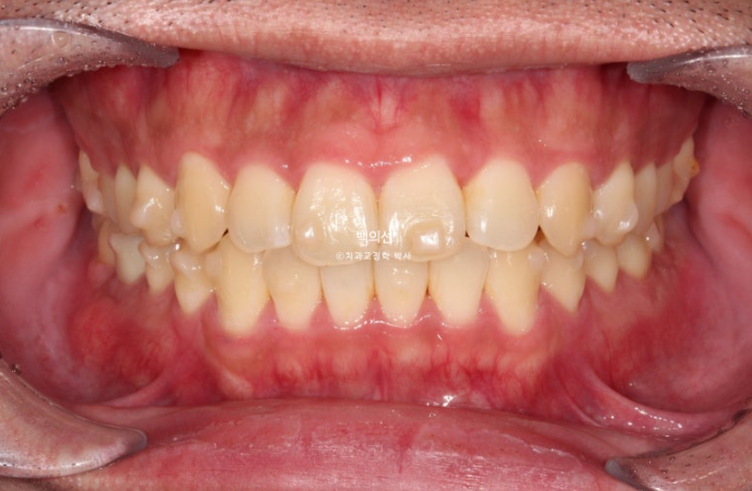 가위교합 나비치아 미니스크류 덧니 교정 인비절라인 라이트 관련 이미지 12