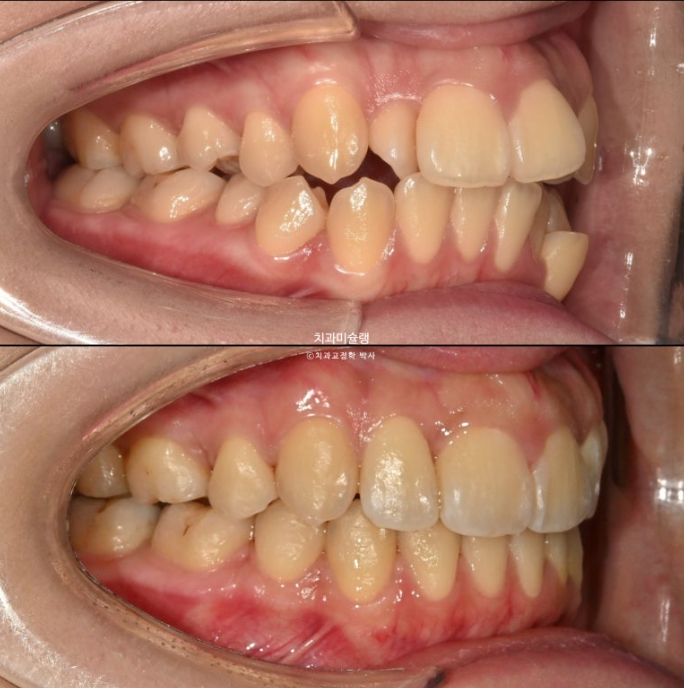 30대 인비절라인 덧니 발치교정 개방교합 치료 관련 이미지 23