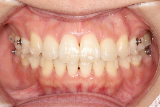 30대 돌출입 덧니 교정 인비절라인 발치교정 후기 관련 이미지 12