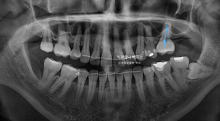 옥니 교정 역교정 재교정 무턱교정 치료기간 1년 10개월 관련 이미지 5