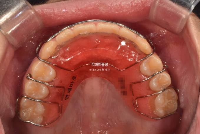 선천적 결손 잔존유치 과개교합 돌출입 인비절라인 퍼스트 어린이 투명교정 치료기간 관련 이미지 18