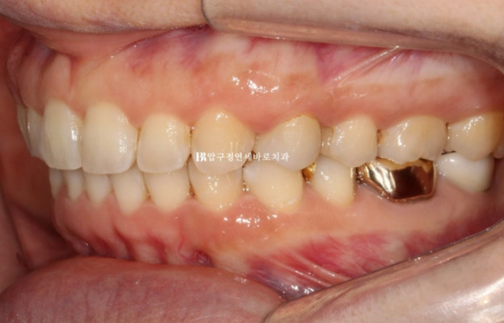 인비절라인 캔팅 교정 과개교합 교정 임플란트 재교정 관련 이미지 10