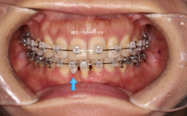 40대 치아교정 가능할까요? 치주염 있어도 치아교정 가능할까요? 임플란트 없이 교정하기 관련 이미지 7