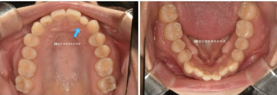 급속 교정 앞니부분교정 치료 무삭제 라미네이트 후기 관련 이미지 3