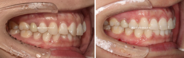 웃을 때 잇몸이 보여요. 잇몸미소 거미스마일 교정하기 관련 이미지 7