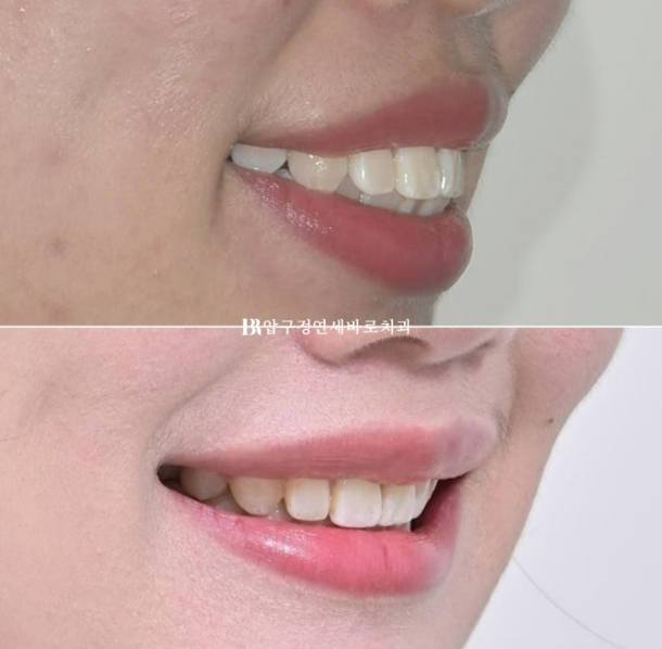 How Do the Buccal Corridors and Smile Line Change After Extraction Treatment for Protruding Teeth?|An Orthodontic Case That Also Improved Lip Incompetence image 1