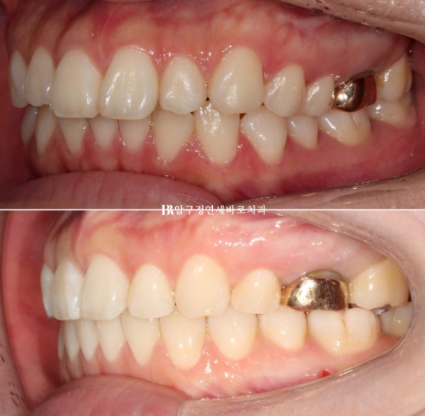 Gummy Smile Correction Review | Natural Improvement of Gummy Smile and Buccal Corridors Through Extraction Treatment for Protruding Teeth image 13