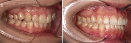 앞니 부분교정은 어떤 경우에 가능한가요? 단기 앞니 부분교정 왜소치 치료 무삭제 라미네이트 관련 이미지 12