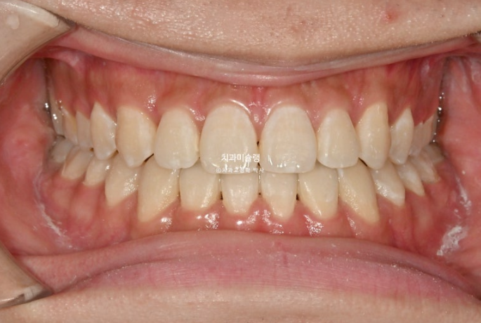 비수술 비발치 주걱턱 절충치료 클리피씨 개방교합 반대교합 치료 관련 이미지 10