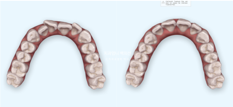 앞니 부분교정 덧니 교정 블랙트라이앵글 부정교합 마모 시뮬레이션 치료기간 5개월 관련 이미지 6