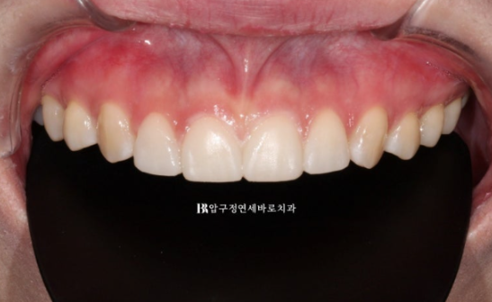 왜소치·원추형 치아, 교정보다 무삭제 라미네이트가 좋은 이유 | 앞니 벌어짐 치료 후기 관련 이미지 6