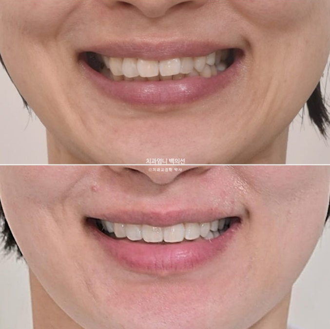 50대 캔팅 교합평면 기울어짐 덧니 교정 인비절라인 라이트 교정? 관련 이미지 12