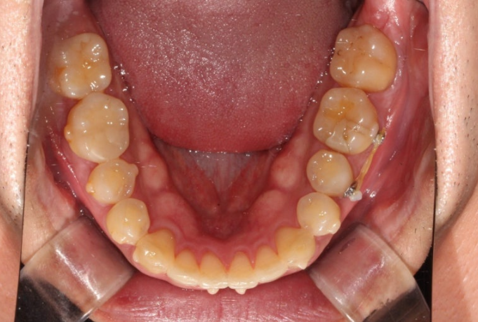 가위교합 벌어짐 중심선 과개교합 인비절라인 라이트 교정 관련 이미지 11