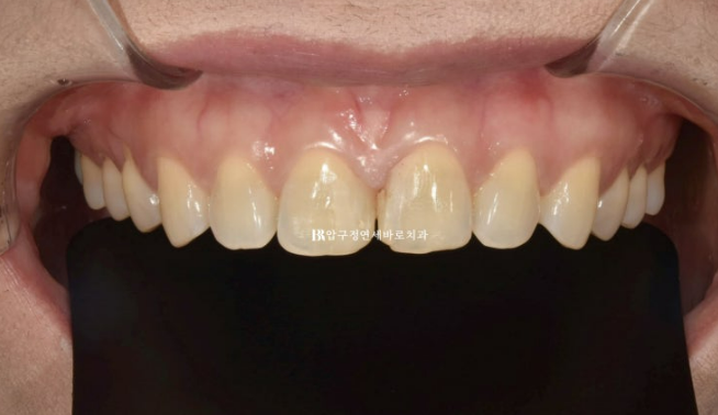벌어진 치아 교정 인비절라인 라이트 무삭제 라미네이트 치료 관련 이미지 3