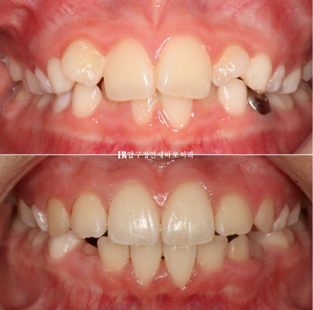 소아 투명교정 인비절라인 퍼스트 후기 기록 관련 이미지 16