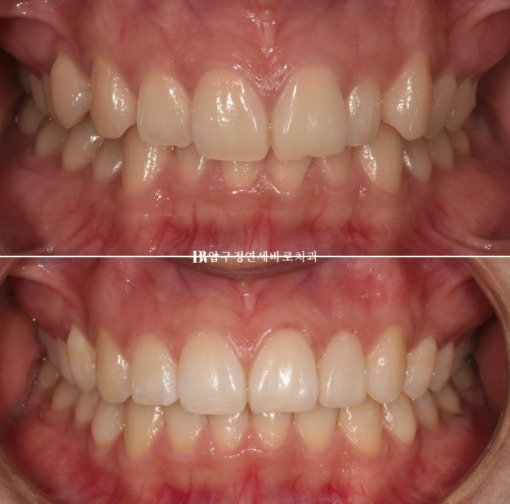 앞니 부분교정은 어떤 경우에 가능한가요? 단기 앞니 부분교정 왜소치 치료 무삭제 라미네이트 관련 이미지 1