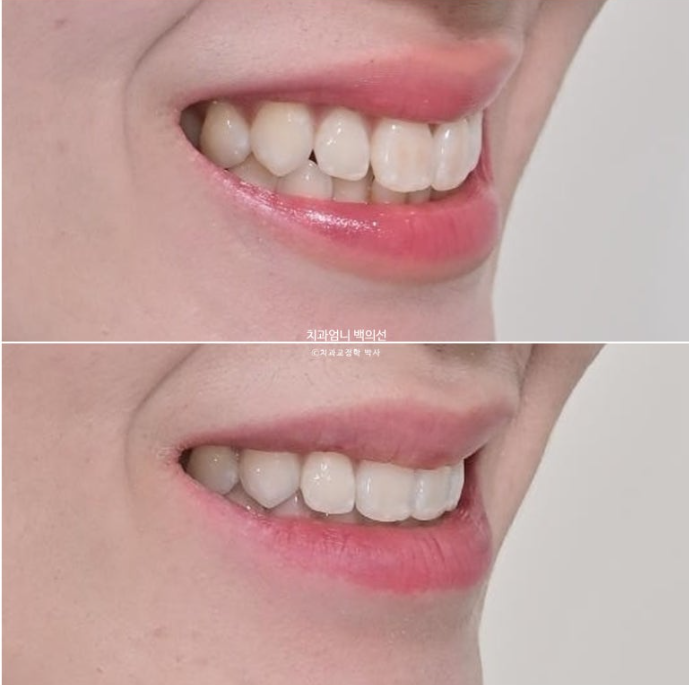인비절라인 라이트 교정 앞니돌출 과개교합 덧니 교정 관련 이미지 12