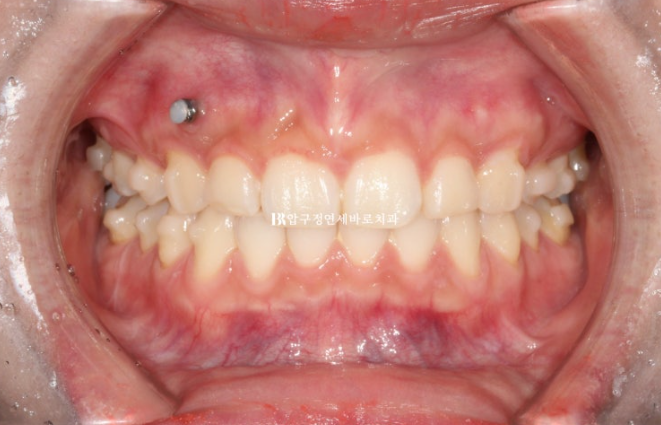 인비절라인 돌출입 발치교정 거미스마일 잇몸미소 교정 관련 이미지 6