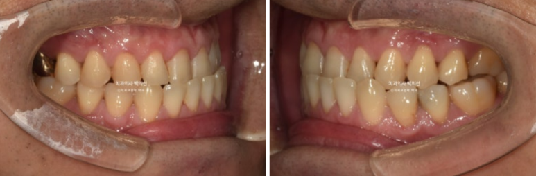 40대 인비절라인 비수술 비발치 주걱턱 비대칭 교정 관련 이미지 3