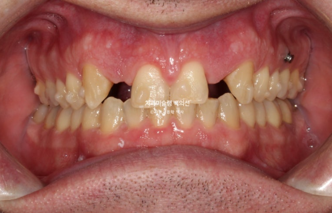 앞니 선천적 결손 인비절라인 임플란트 과개교합 치료 기간 관련 이미지 15