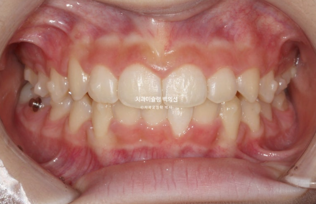 과개교합 인비절라인 모더레이트 컴프레헨시브 중심선 토끼이빨 관련 이미지 7