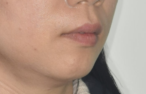 40대 치아교정 가능할까요? 치주염 있어도 치아교정 가능할까요? 임플란트 없이 교정하기 관련 이미지 3