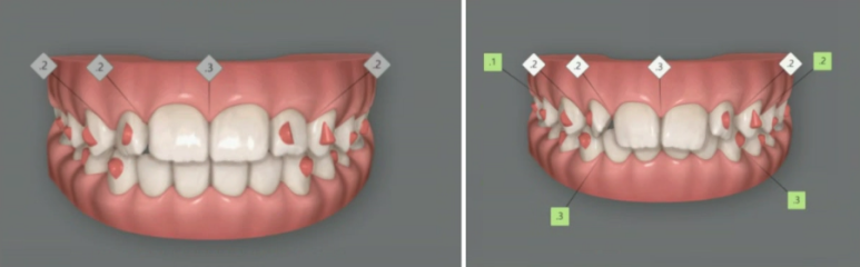 서울 인비절라인 덧니 교정 과개교합 후기 관련 이미지 3