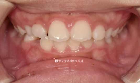 강남 소아교정 인비절라인 퍼스트 어린이 반대교합 관련 이미지 2