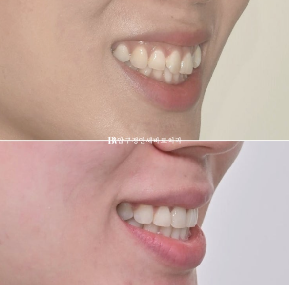 거미스마일 교정 전후 비교|웃는 얼굴이 달라졌습니다 관련 이미지 12