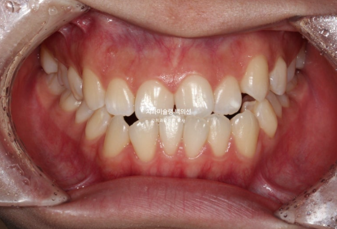 비수술 주걱턱 비대칭 발치 교정 결손치 반대교합 클리피씨 치료기간 1년 11개월 관련 이미지 2