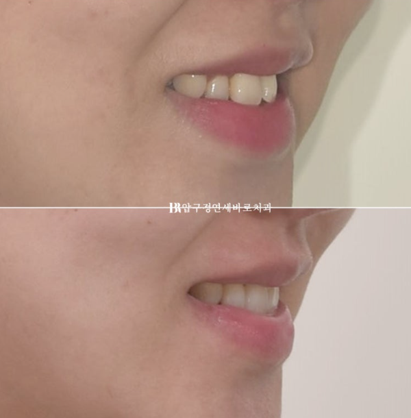 Is compliance important for Invisalign? | A real case that improved reverse bite and scissors bite in 8 months image 14