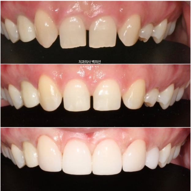 앞니 선천적 결손 벌어짐 잔존 유치 무삭제 라미네이트 관련 이미지 12