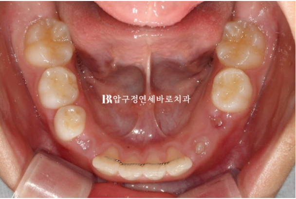 어린이 무턱 성장교정, 인비절라인 퍼스트 MA로 치료한 골격성 II급 부정교합 증례 관련 이미지 18