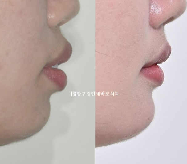 How Do the Buccal Corridors and Smile Line Change After Extraction Treatment for Protruding Teeth?|An Orthodontic Case That Also Improved Lip Incompetence image 17