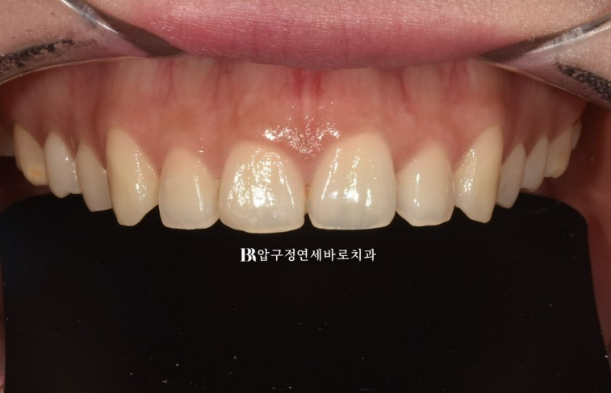 How to Create a Beautiful Smile Line? | A Real Case of Changing a Smile with No-Prep Laminates image 3