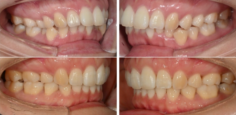 돌출입 덧니 발치 교정 인비절라인 교정 후기 관련 이미지 25
