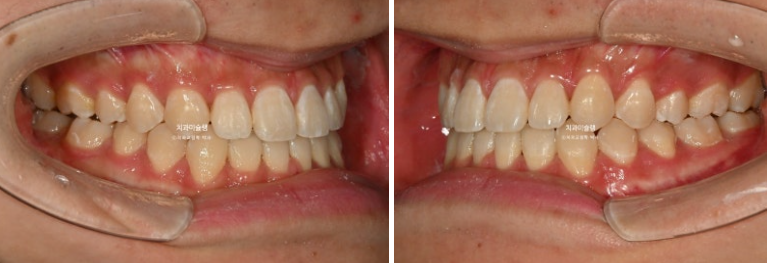 비수술 비발치 주걱턱 절충치료 클리피씨 개방교합 반대교합 치료 관련 이미지 11